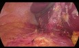 Laparoscopic Liver Abscess Drainage (Segment 7) and Cholecystectomy in a Super Obese Patient (BMI 70)
