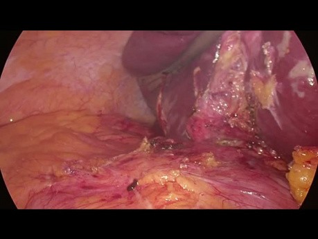 Laparoscopic Liver Abscess Drainage (Segment 7) and Cholecystectomy in a Super Obese Patient (BMI 70)