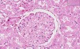 Kidney - Systemic Lupus Erythematosus
