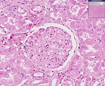 Kidney - Systemic Lupus Erythematosus