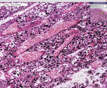 Lymph Node - Anthracosis - Tuberculosis