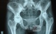 Bilateral AVN femoral heads