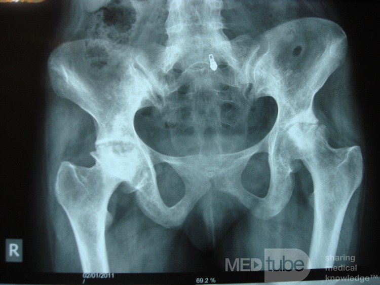 Bilateral AVN femoral heads