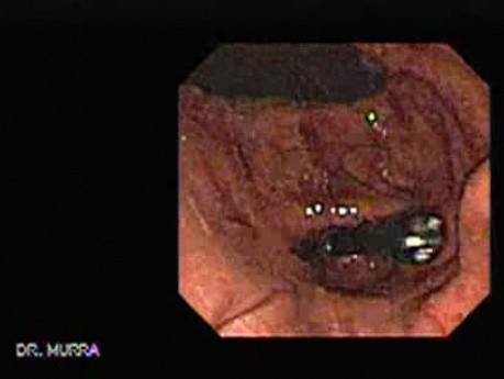 The Upper Gastrointestinal Tract - Video Endoscopic Sequence (5 of 6)