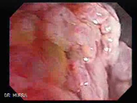Villous Colon Adenocarcinoma (2 of 12)