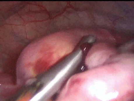 Torsion of Adnexal Mass