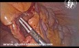 Laparoscopic Resection of a Appendiceal Mucocele