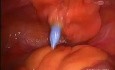 Laparoscopic Hysterectomy with Pelvic Lymphadenectomy in Patient with BMI = 65
