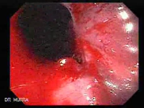 Long Standing Alcohol Abuse - Spurting Esophageal Varix