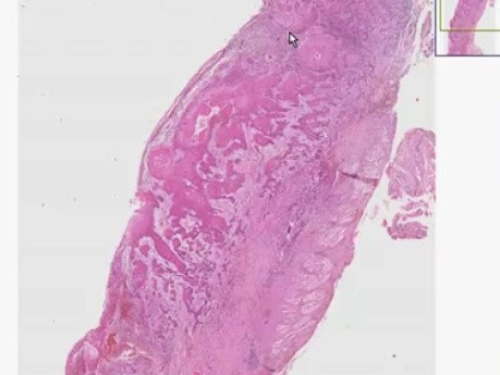 Tongue - Squamous cell carcinoma