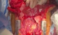 TA NRP and Lung and Heart Donation after DCD 