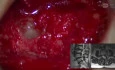 Adhesiolysis L2/L3/L4 + Removal of Large Disc Herniations: L2/L3/4 TLIF: L2/3 (Right), L3/4 (Left)