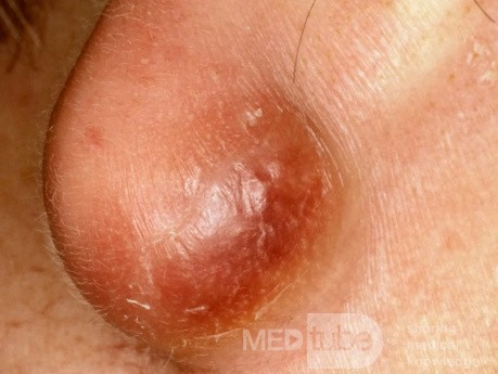 Infected Epidermal Inclusion Cyst