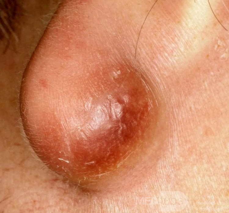 Infected Epidermal Inclusion Cyst