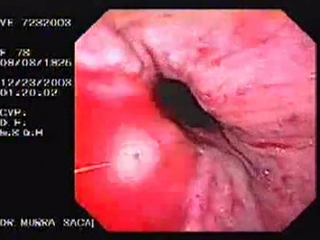 Hemorrhage due status post rubber band ligation of esophageal varices (21 of 25)
