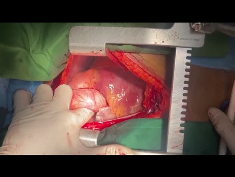 Off Pump CABG Management of Low LVEF Patient with EF 5 to 10 Percent and PHTN