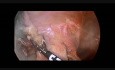 Laparoscopic Resection of Giant Left Ovarian Cyst