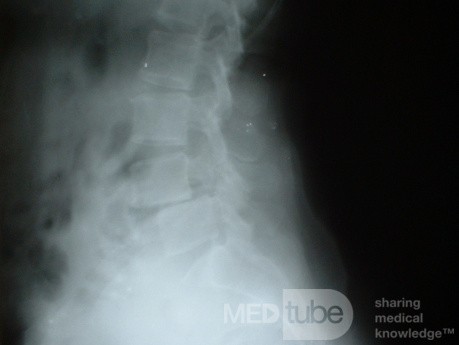 Spondylolesthesis L4-5