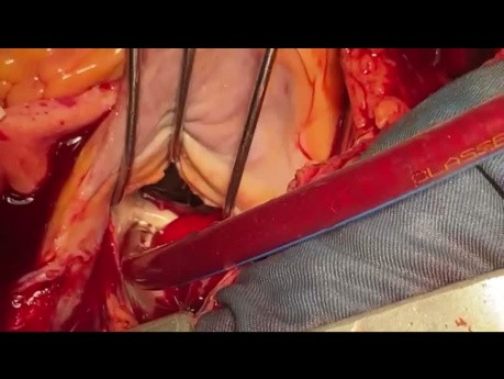 ESRD Patient with Dialysis Candidate for BE Excision 