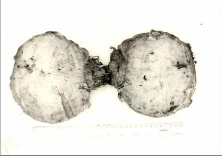 Largest Paratesticular Tumour Ever Reported In The World