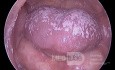Oral Thrush (Candidiasis)