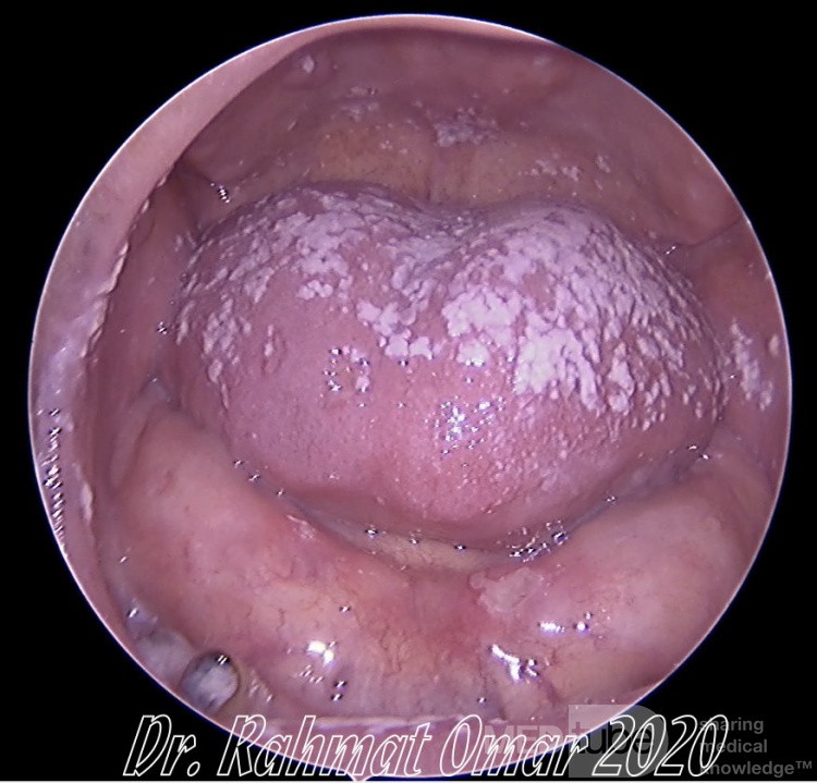 Oral Thrush (Candidiasis)