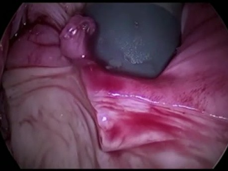 Contained Mechanical Morcellation in Gynecology