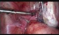 Laparoscopic Management of Ovarian Haematoma & Haemoperitoneum