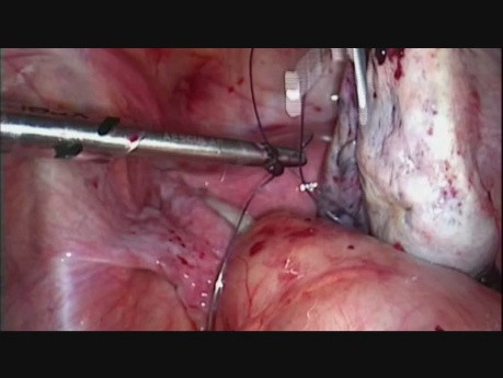 Laparoscopic Management of Ovarian Haematoma & Haemoperitoneum