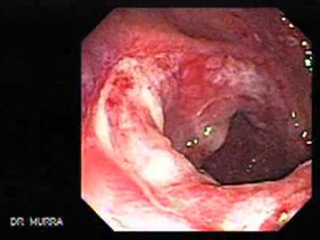 Multiple Adenomatous Polyps Of The Rectum (31 of 37)