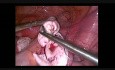 Mucinous Cyst Removal with Ovarian Recontruction