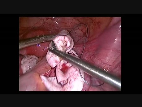 Mucinous Cyst Removal with Ovarian Recontruction