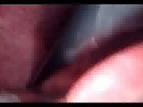 Colonic Perforation With Peritonitis - Laparoscopy (42 of 46)
