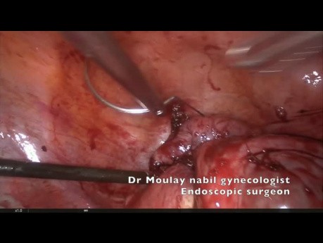 Complex  laparoscopic polymyomectomy