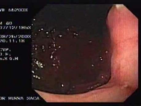 Acute Variceal Bleeding - Ligated Varix