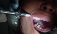 Softly, Doucement, Dental Palatal Anesthesia