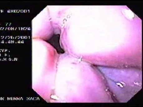 Hemorrhage Due Status Post Rubber Band Ligation of Esophageal Varices - Insertion of the Endoscope