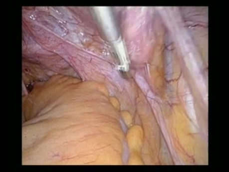 Total laparoscopic histerectomy (TLH)