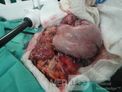 Gastric Ulcerated Adenocarcinoma of the Pre-pyloric Antrum (19 of 28)
