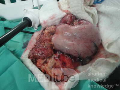 Gastric Ulcerated Adenocarcinoma of the Pre-pyloric Antrum (19 of 28)