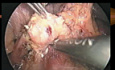 Endocrine Tumours of the Pancreas