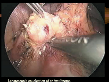 Endocrine Tumours of the Pancreas