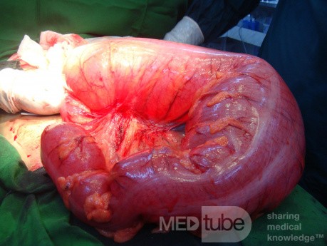 Sigmoid Volvulus