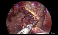 Post Hysterectomy Ectopic Pregnancy