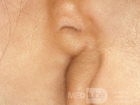Microtia of the Ear [left]