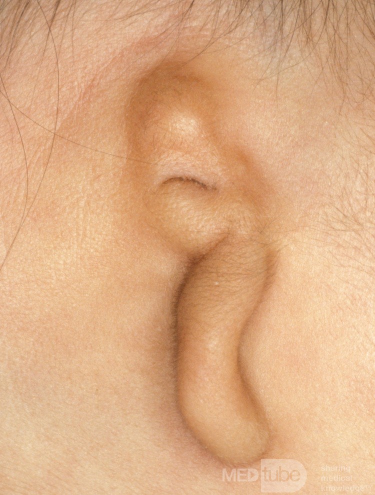 Microtia of the Ear [left]