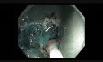 Colonoscopy Channel - EMR of a Large Flat Lesion