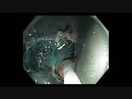 Colonoscopy Channel - EMR of a Large Flat Lesion