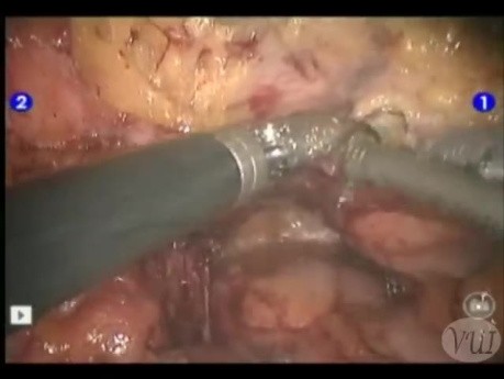 Robotic Assisted Management Of Ureterovaginal Fistula