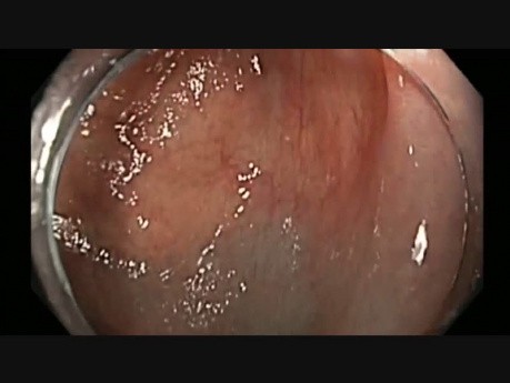 Colonoscopy - Ascending Colon Polyp EMR after Prior Failed Resection